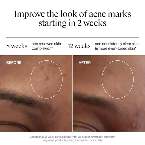 Neutrogena Evenly Clear Retinoid Adapalene Gel 0.1% Acne Spot Treatment, Once-Daily Topical Retinoid Helps Clear Breakouts & Visible Improvement in the Appearance of Post-Acne Mark, 0.5 oz