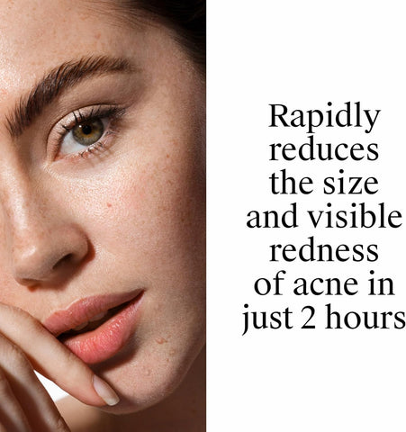 Neutrogena Rapid Clear Stubborn Acne Spot Treatment Gel, Maximum Strength 10% Benzoyl Per-oxide Treatment Medication for Acne Prone Skin, Pimple Cream Reduces Size & Redness, 1 oz