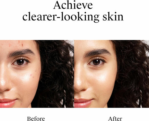 Neutrogena Rapid Clear Stubborn Acne Spot Treatment Gel, Maximum Strength 10% Benzoyl Per-oxide Treatment Medication for Acne Prone Skin, Pimple Cream Reduces Size & Redness, 1 oz